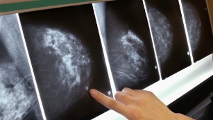 Third of breast cancer patients treated unnecessarily, study says