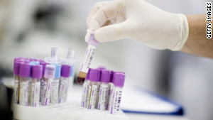 Experts reverse themselves on prostate cancer screenings