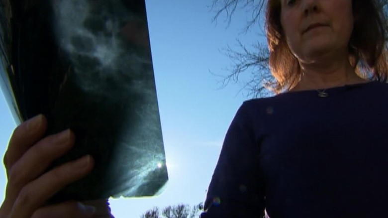 The downsides of mammograms_00013610